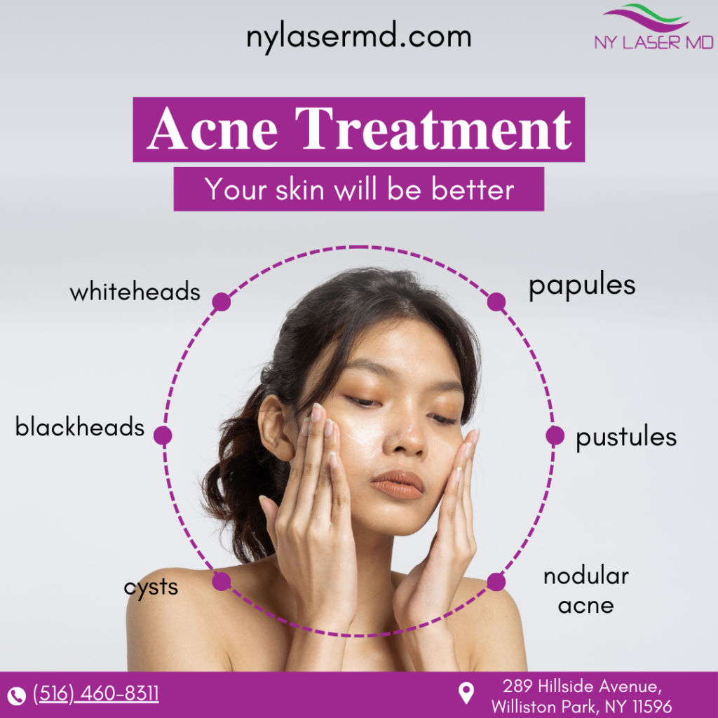 acne treatment